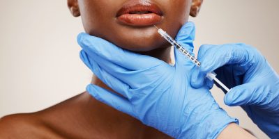 A patient receiving natural-looking lip fillers in Tuscaloosa from an anesthesiologist.