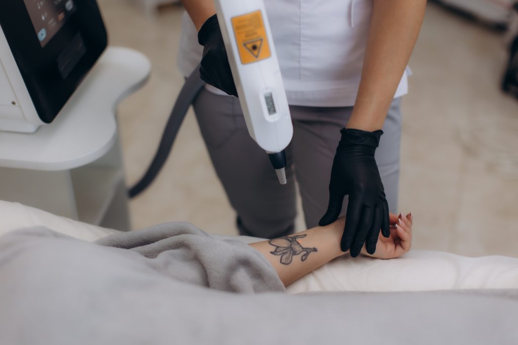 Close-up of a laser tattoo removal session on a forearm at Tuscaloosa MedSpa using MedLight technology.
